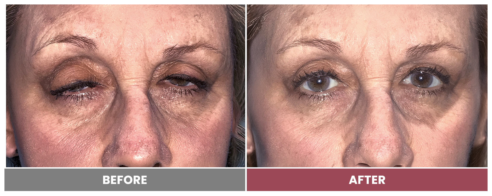 PTOSIS REPAIR - Case 33